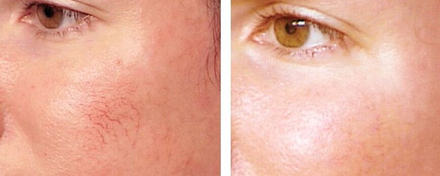 Rosacea- ի հեռացում